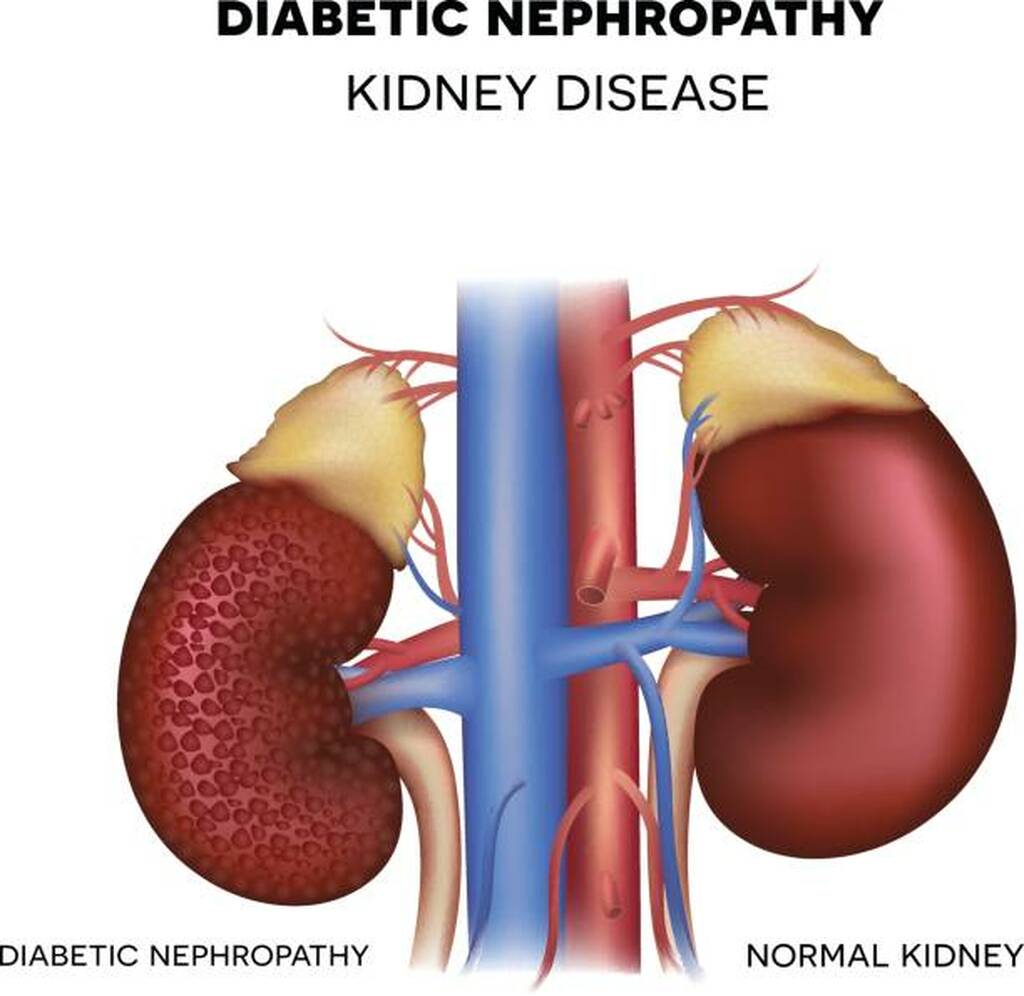 Best Doctor for Diabetic Kidney Disease & Chronic Kidney Disease (CKD) in South Mumbai